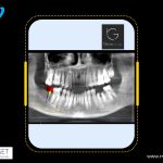 Case - 169