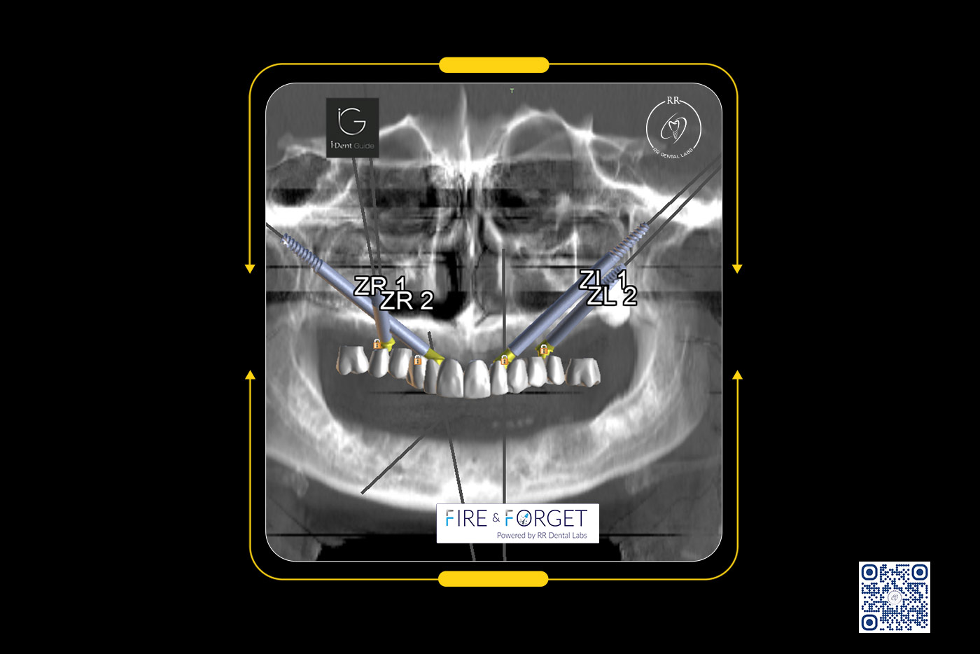 Case – 218