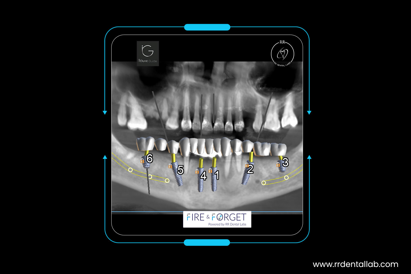 Case – 216